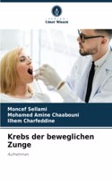 Krebs der beweglichen Zunge