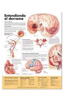 Understanding Stroke Anatomical Chart in Spanish (Entendiendo qué es un derrame)