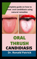 Oral Thrush Candidiasis