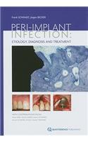 Peri-Implant Infection: Etiology, Diagnosis and Treatment