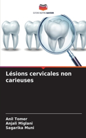 Lésions cervicales non carieuses