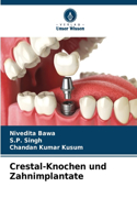 Crestal-Knochen und Zahnimplantate
