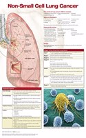 Non-Small Cell Lung Cancer, Chart Laminated