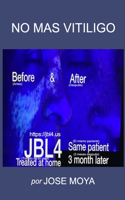 No Mas Vitiligo