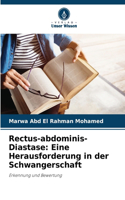 Rectus-abdominis-Diastase